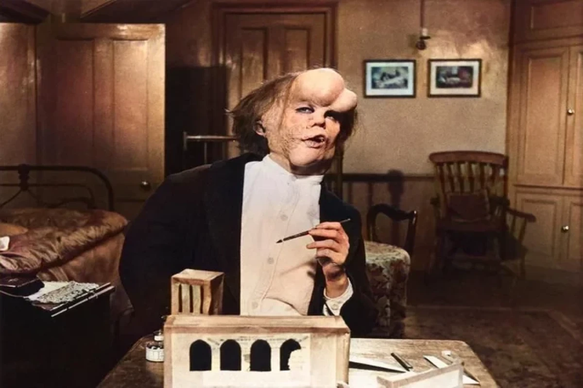 Növbəti "Fil adam" o olacaq